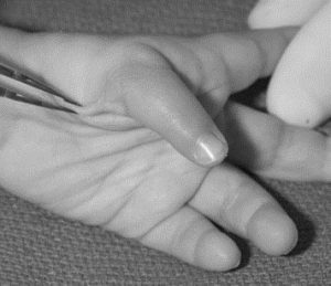 Clinical Care of Hand and Arm Abnormalities in Fanconi Anemia - Fanconi ...